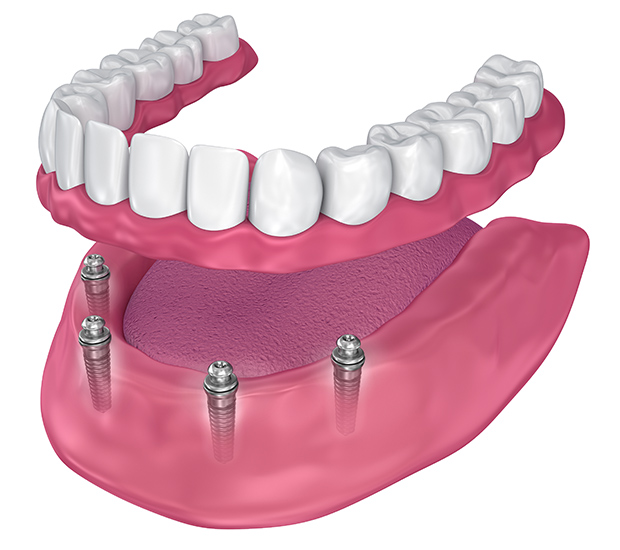Good Gum Health = Good Whole-Body Health - Roselle Park Dental & Implants  Blog