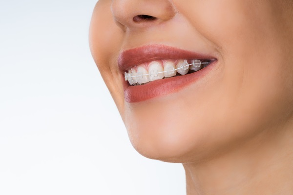 Why Clear Braces Are A Popular Option For Teeth Straightening