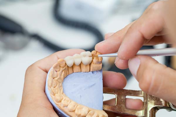 How Many Missing Teeth Can A Dental Bridge Replace?