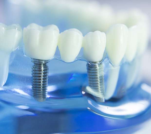 Union Dental Implants