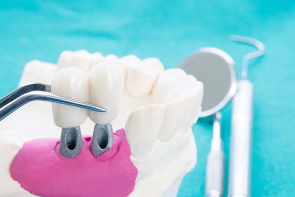 How Implant Supported Dentures Can Benefit Your Oral Health